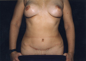 Breast Reconstruction 3b
